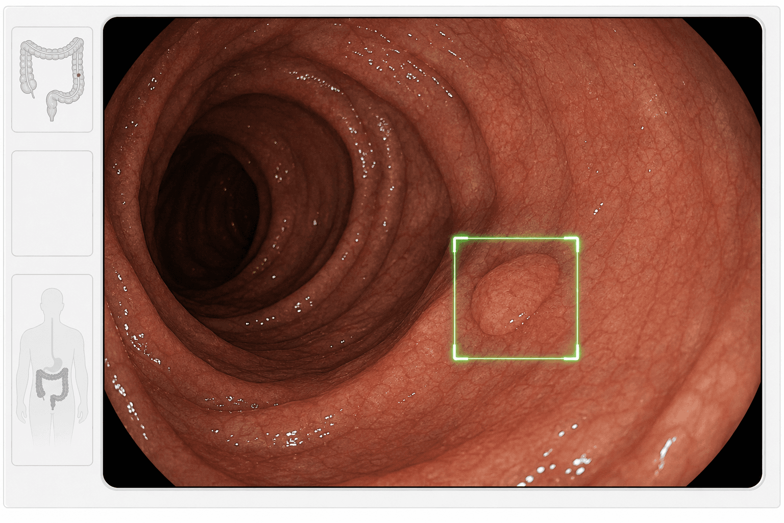 Endoscopic view of the colon interior with a small flat polyp highlighted by a green AI bounding-box overlay, illustrating real-time computer-aided detection during colonoscopy withdrawal.