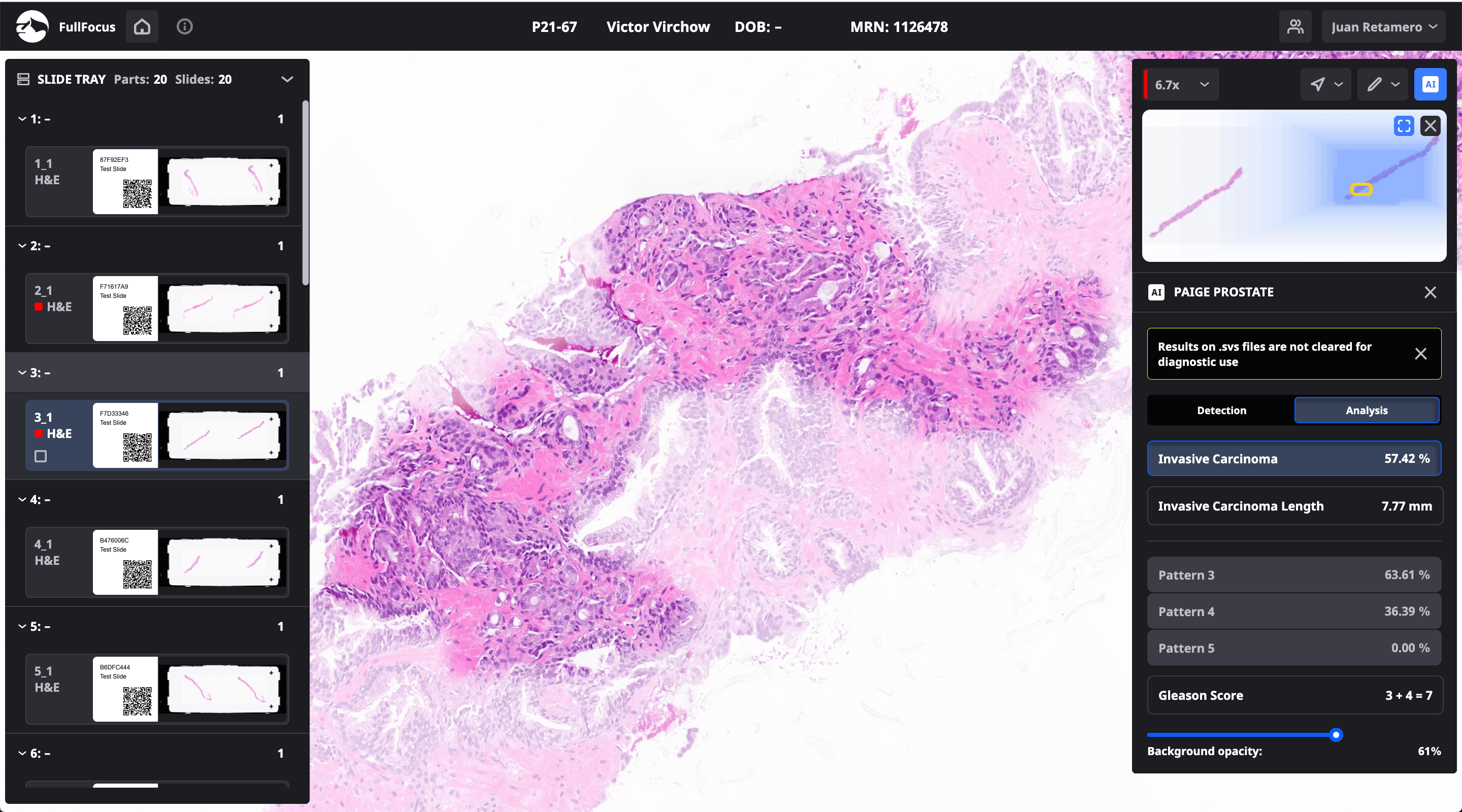 Screenshot of the Paige Prostate Grade and Quantify interface within the Sectra digital pathology viewer, showing AI-generated overlay regions on a prostate biopsy whole slide image alongside the slide overview panel.