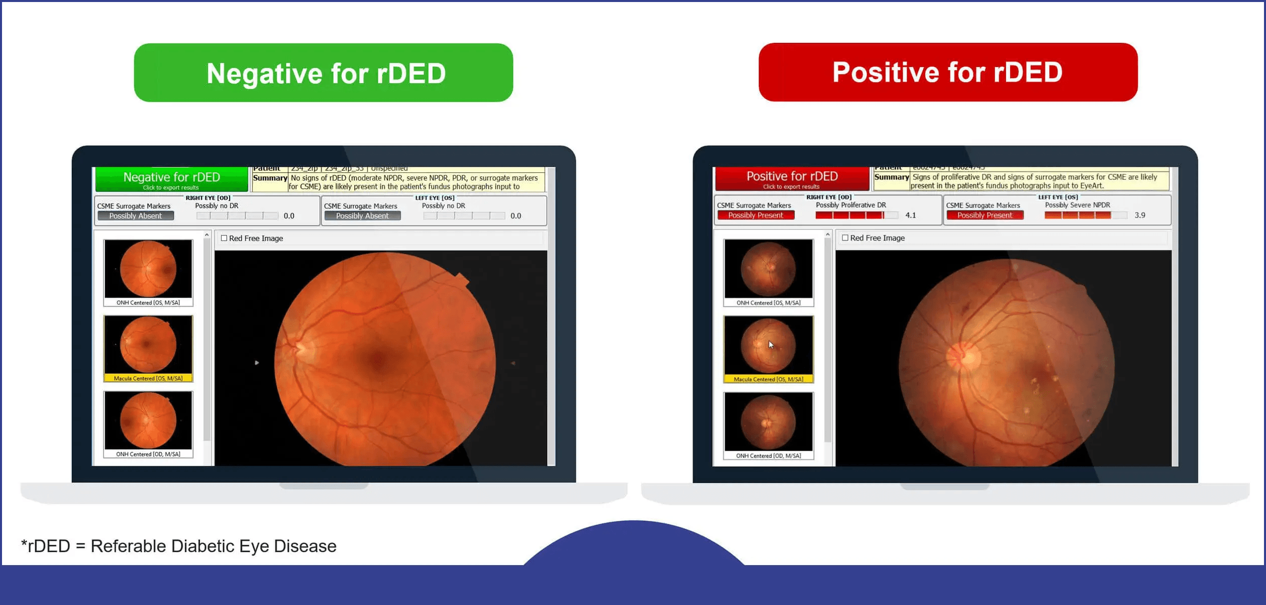 Clinical graphic showing EyeArt AI diabetic retinopathy screening accuracy metrics alongside low real-world adoption data